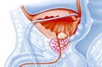 Prostate Cancer