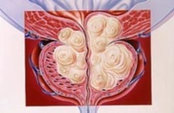 Prostate Adenoma